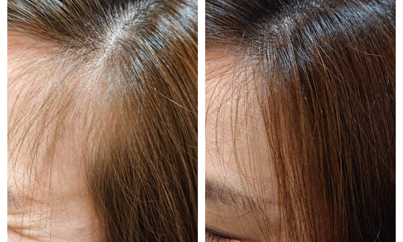 髪のボリュームアップ 増毛エクステ フエール で前髪や分け目の悩みも解消 Hanabusa Co Medical